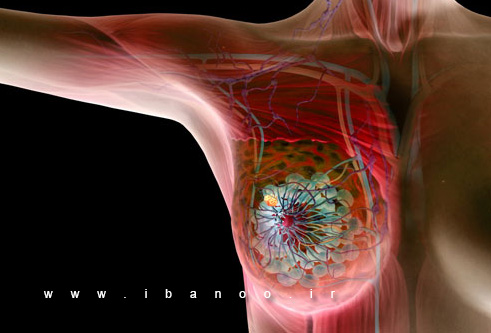 breast-cancer-1.jpg