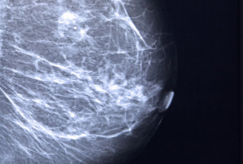 breast-cancer-4.jpg